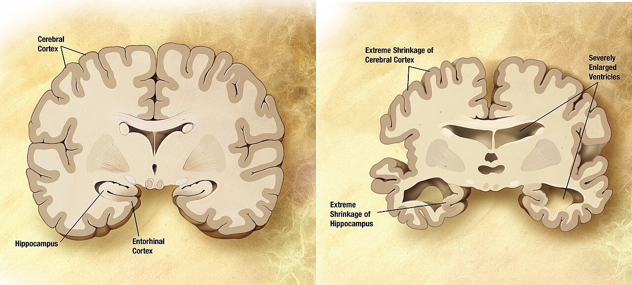 Comparison of a normal brain on the left and a brain with severe Alzheimer's disease on the right